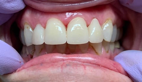 After veneers