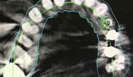 CT X-Ray